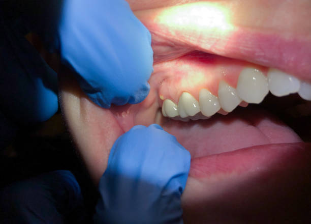 Best Emergency Root Canal Treatment in Webb City, MO